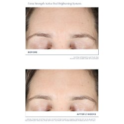 Is Clinical Extra Strength Active Peel Brightening System 