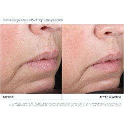 Is Clinical Extra Strength Active Peel Brightening System 
