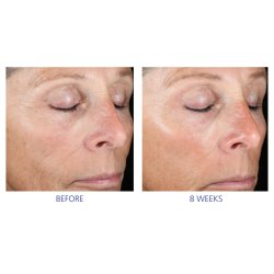 Is Clinical Active Peel System