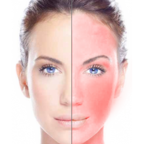 Rosacea