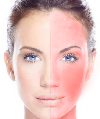 Rosacea